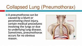 Image result for Signs of Collapsed Lung