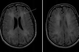 Image result for Toxic Leukoencephalopathy