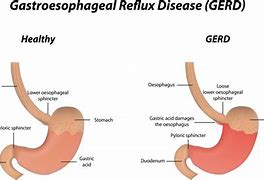 Image result for Esophageal Sphincter Spasm