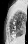 Image result for Osseous Metastatic Disease