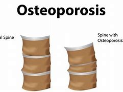 Image result for Osteoporosis Lumbar Spine