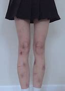 Image result for Blood Bruise Aesthetic