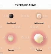 Image result for Pustule Pimple