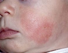 Image result for Baby Face Bug