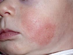 Image result for Eczema On Baby Arm