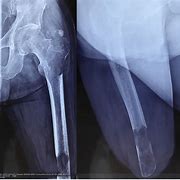 Image result for X-ray Bone Soft Tissue