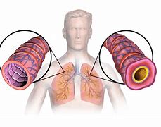 Image result for Lungs of a Person with Asthma