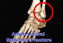 Image result for Lateral Malleolus Fracture Splint