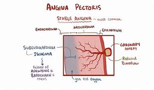 Image result for Stable Angina Pectoris