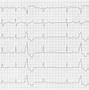 Image result for Premature Atrial Contraction