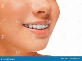 Image result for Fixed Braces Teeth Side View