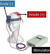 Image result for What Is a tDCS