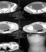 Image result for Retrocaval Cyst