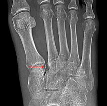 Image result for Avulsion Fracture