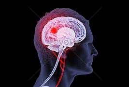 Image result for Brain Cancer Photo Human