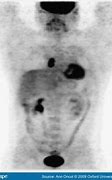 Image result for Pet Scan Lymphoma Example