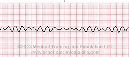 Image result for Ventricular Fibrillation EKG Examples