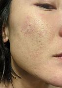 Image result for Banish Acne Scars