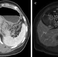 Image result for Spleen Enlargement CT