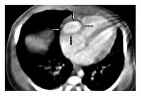 Image result for Right Atrial Appendage Aneurysm