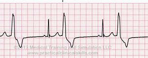 Image result for Bigeminy PVC ECG