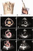 Image result for Right Parasternal View Echo