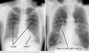 Image result for Chest X-Ray Lungs