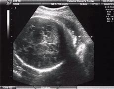 Image result for Head Circumference 37 Weeks Ultrasound