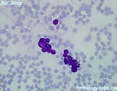 Image result for Adrenal Cytology