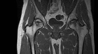 Image result for Avascular Necrosis Pathology