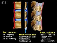 Image result for Lumbar Compression Burst Fractures