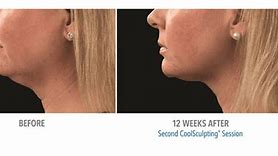 Image result for CoolSculpting Chin Before and After