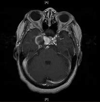 Image result for Aneurysm in MRI