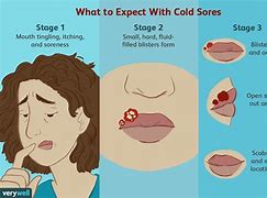 Image result for Cold Sore On Tongue