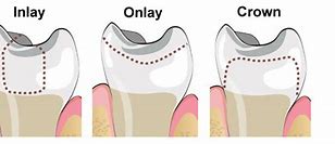 Image result for Inlay Crown