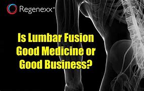 Image result for Lumbosacral Fusion