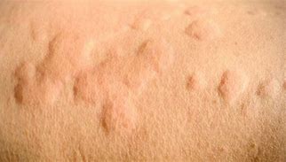 Image result for Benign Skin Bumps