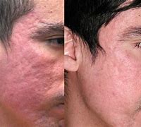 Image result for Acne Scars Men