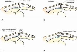 Image result for Volar vs Dorsal