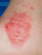 Image result for Pink Blotches On Skin