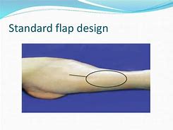 Image result for Anterolateral Thigh Flap