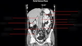 Image result for Abdomen CT Cor