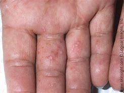 Image result for Best Treatment for Dyshidrotic Eczema