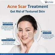 Image result for Acne Scars Home Remedy