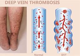 Image result for Post-Thrombotic Syndrome