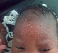 Image result for Pustules On Forehead