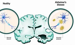 Image result for ALZ Disease