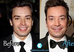 Image result for Jimmy Fallon Plastic Surgery