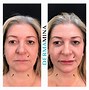 Image result for Chin Correction Filler