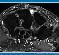 Image result for Palmar Bowing of the Flexor Retinaculum